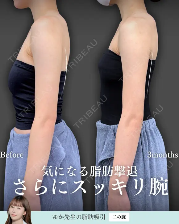 脂肪吸引(二の腕) before画像 メイン用
