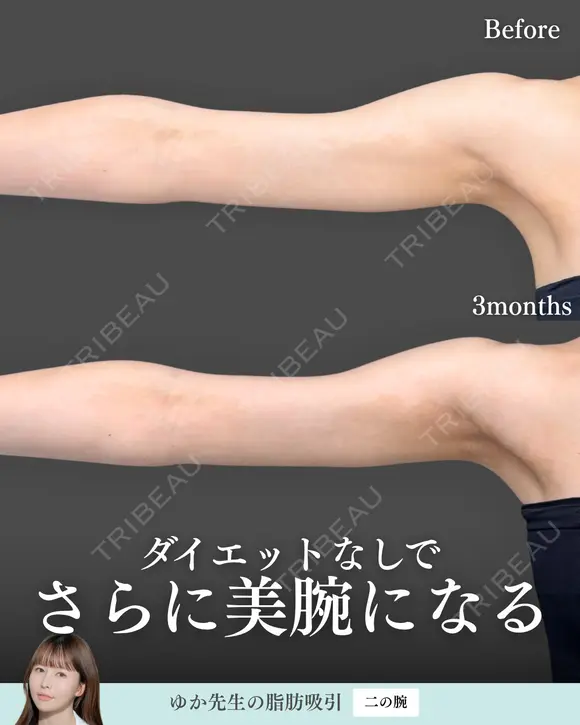 脂肪吸引(二の腕) 180日後 メイン用