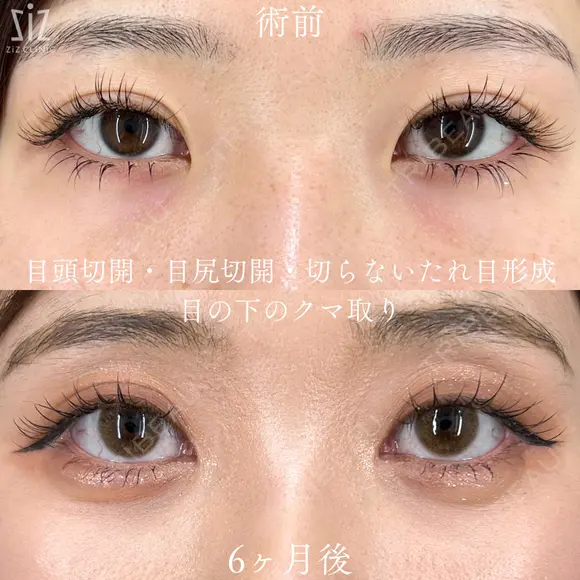 【目元整形】優しい目元にアップデート before画像 メイン用