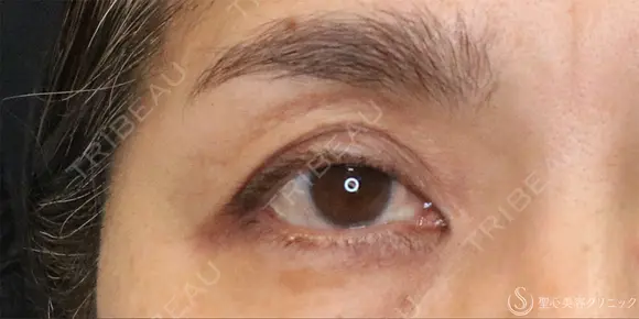 【50代女性・切らずに目の開き改善】眼瞼下垂埋没法（1ヶ月後） before画像 メイン用