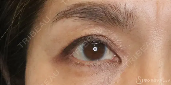 【50代女性・切らずに目の開き改善】眼瞼下垂埋没法（1ヶ月後） 30日後 メイン用