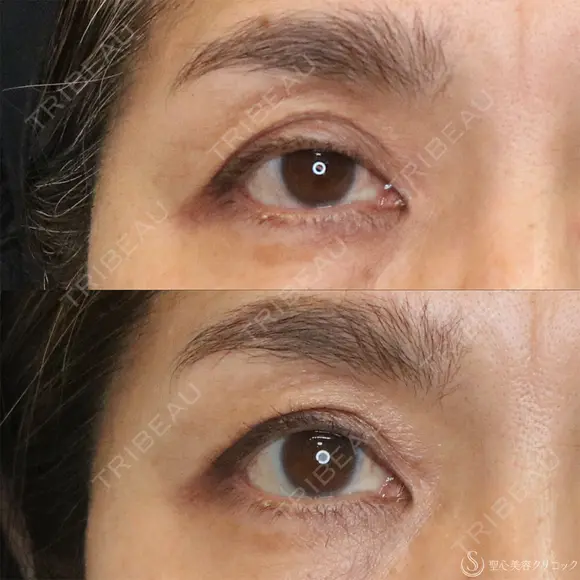 【50代女性・切らずに目の開き改善】眼瞼下垂埋没法（1ヶ月後） 30日後 メイン用