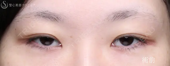 【30代女性・目力を改善】眼瞼下垂手術＋目頭切開（4ヶ月後） before画像 メイン用