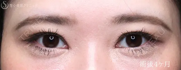 【30代女性・目力を改善】眼瞼下垂手術＋目頭切開（4ヶ月後） 120日後 メイン用