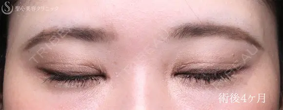 【30代女性・目力を改善】眼瞼下垂手術＋目頭切開（4ヶ月後） 120日後 メイン用