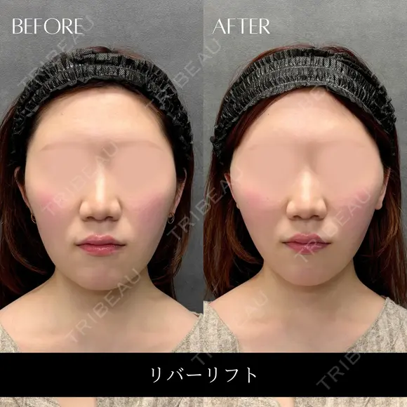 リバーリフト after画像 メイン用