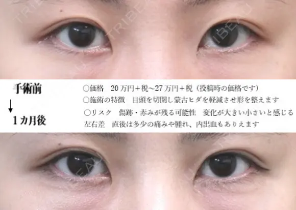 目頭切開法 30日後 メイン用