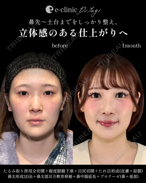 鼻整形×目元整形 after画像 メイン用