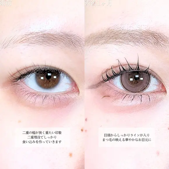 アリエルクイックループトリプル二重埋没法/涙袋ヒアルロン酸 before画像 メイン用