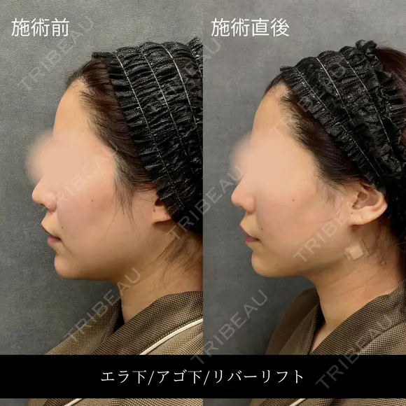 リバー式小顔脂肪吸引 after画像 メイン用