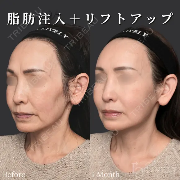 脂肪注入（額・こめかみ・頬）＋糸リフト＋バーティカルリフト after画像 メイン用