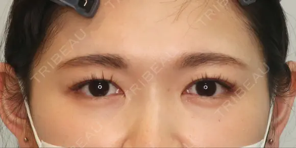 【20代・女性】二重埋没法（マイクロメソッド+α）（１週間後） before画像 メイン用