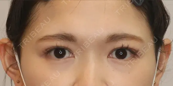 【20代・女性】二重埋没法（マイクロメソッド+α）（１週間後） 7日後 メイン用