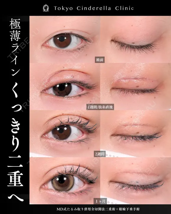 たるみ取り併用全切開法二重術/眼瞼下垂手術/MD式 30日後 メイン用