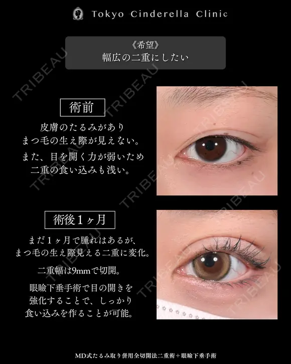 たるみ取り併用全切開法二重術/眼瞼下垂手術/MD式 before画像 メイン用