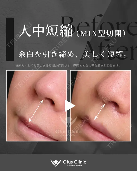 人中短縮（MIX型切開）・鼻翼縮小・鼻翼挙上 30日後 メイン用