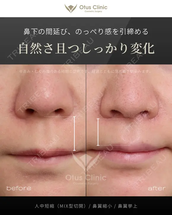 人中短縮（MIX型切開）・鼻翼縮小・鼻翼挙上 before画像 メイン用