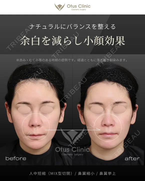 人中短縮（MIX型切開）・鼻翼縮小・鼻翼挙上 30日後 メイン用
