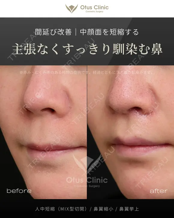 人中短縮（MIX型切開）・鼻翼縮小・鼻翼挙上 before画像 メイン用