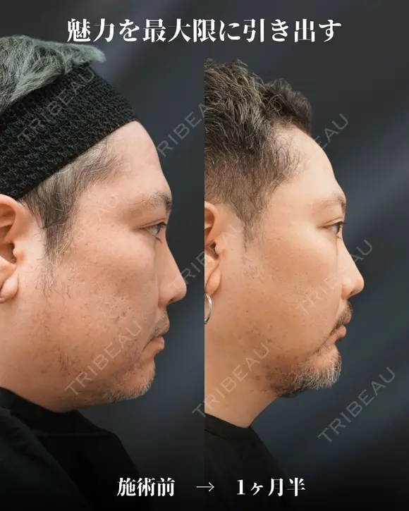 輪郭激変！！ before画像 メイン用
