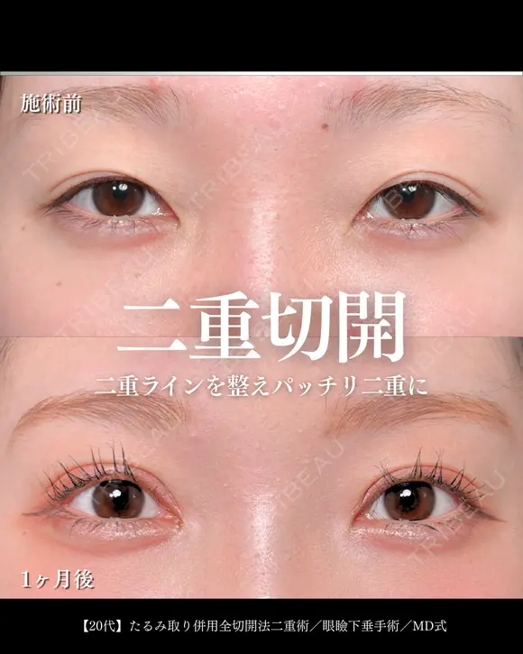 たるみ取り併用全切開法二重術/眼瞼下垂手術/MD式 30日後 メイン用