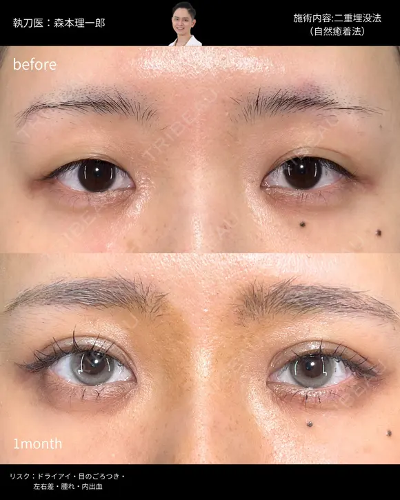 二重埋没（自然癒着法） after画像 メイン用