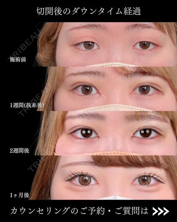 二重埋没法(クイックシンデレラ・トリプル)/ 目頭切開/MD式 before画像 メイン用