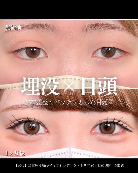 二重埋没法(クイックシンデレラ・トリプル)/ 目頭切開/MD式 30日後 メイン用