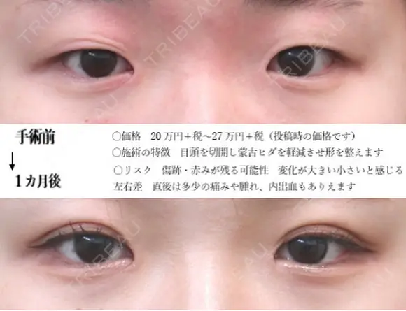 埋没法＋目頭切開法 30日後 メイン用