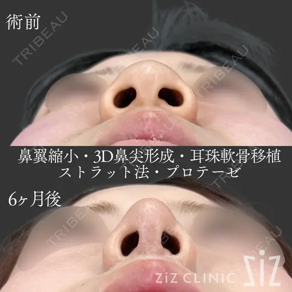 【鼻整形】大学入学前にスッキリ before画像 メイン用