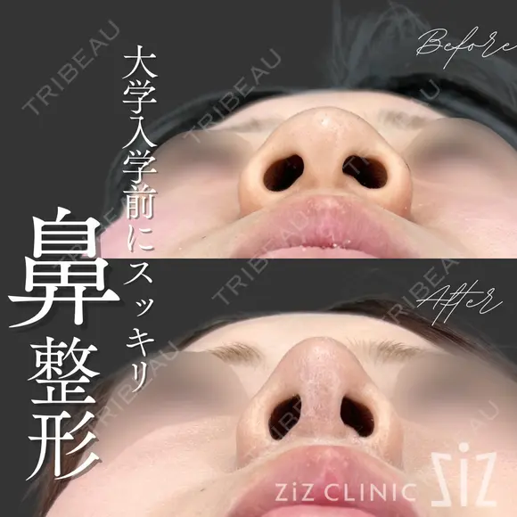 【鼻整形】大学入学前にスッキリ after画像 メイン用