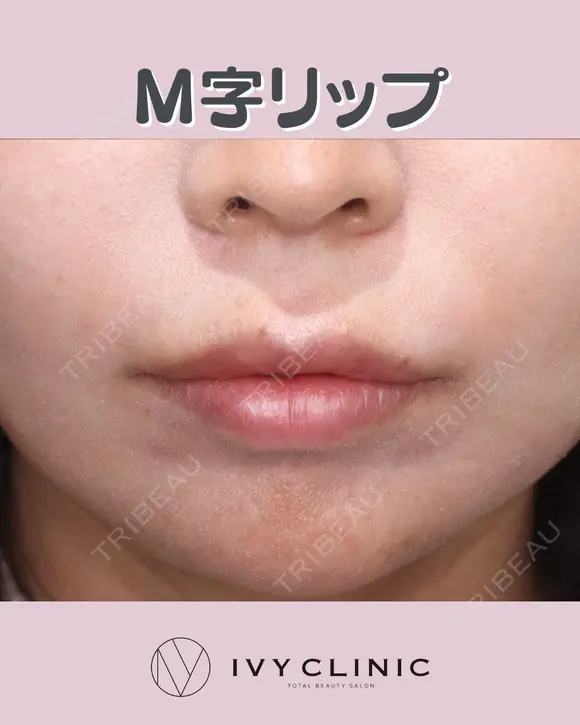 M字リップ after画像 メイン用