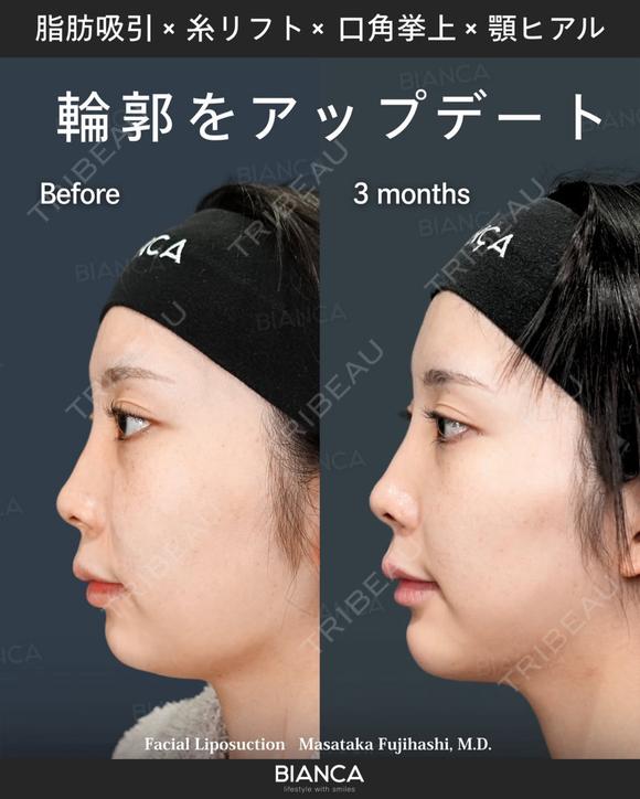 脂肪吸引・糸リフト・口角挙上・ヒアルロン酸・ボトックス after画像 メイン用