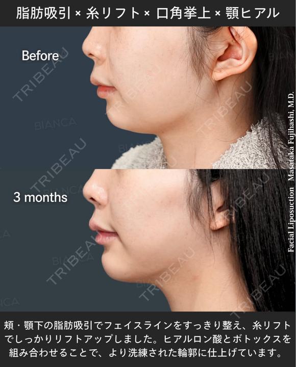 脂肪吸引・糸リフト・口角挙上・ヒアルロン酸・ボトックス after画像 メイン用