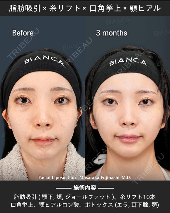 脂肪吸引・糸リフト・口角挙上・ヒアルロン酸・ボトックス after画像 メイン用