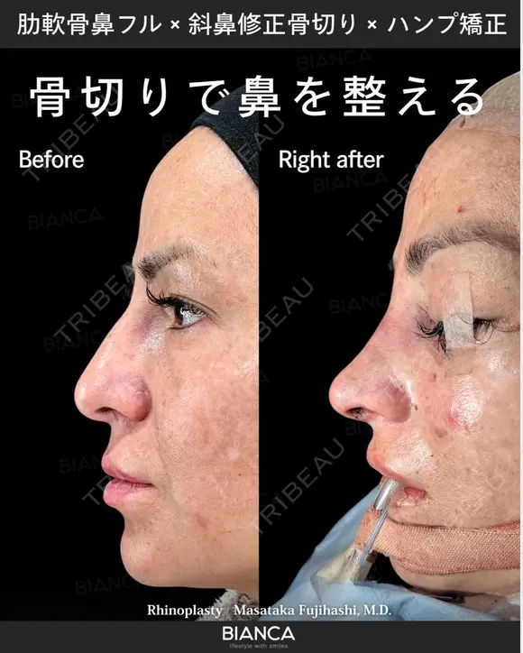 肋軟骨鼻フル・斜鼻修正骨切り・ハンプ矯正 after画像 メイン用