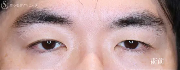 【40代男性・凛々しい目元に】眼瞼下垂＋眉下リフト（1年8ヶ月後） before画像 メイン用