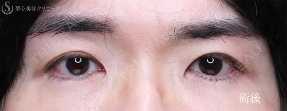 【40代男性・凛々しい目元に】眼瞼下垂＋眉下リフト（1年8ヶ月後） 515日後 メイン用