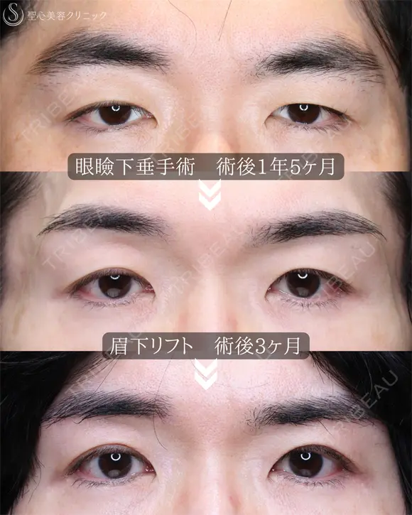 【40代男性・凛々しい目元に】眼瞼下垂＋眉下リフト（1年8ヶ月後） 515日後 メイン用