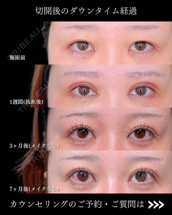 全切開二重術/眼瞼下垂手術/眉下切開/目頭切開/MD式 before画像 メイン用