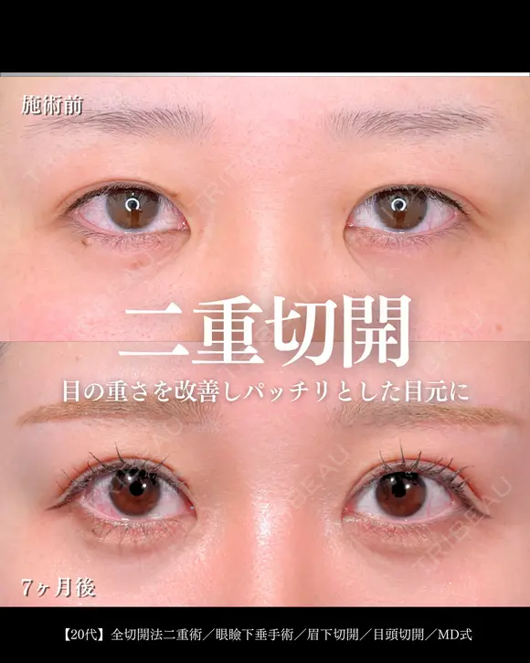 全切開二重術/眼瞼下垂手術/眉下切開/目頭切開/MD式 after画像 メイン用