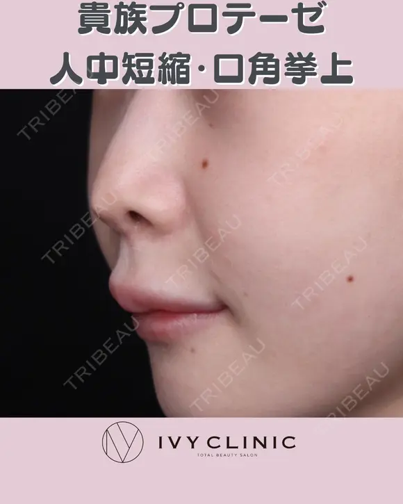 貴族プロテーゼ　人中短縮　口角挙上 before画像 メイン用