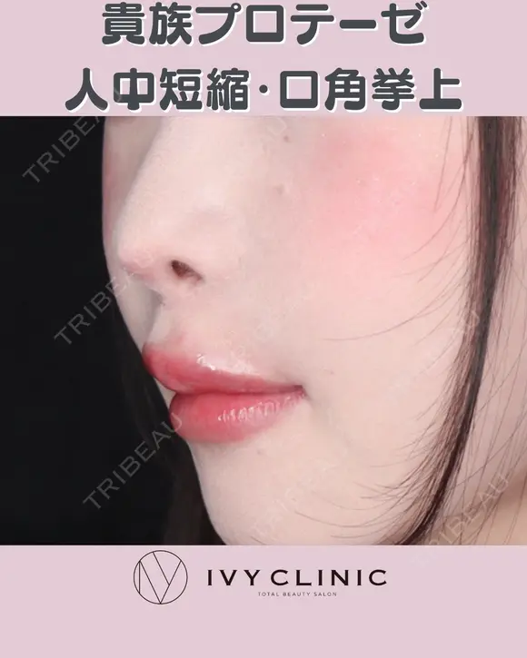 貴族プロテーゼ　人中短縮　口角挙上 after画像 メイン用