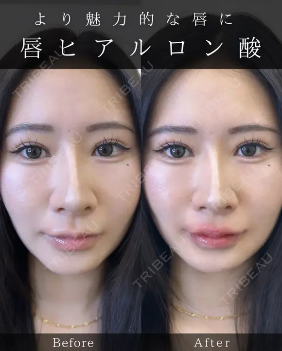 Cカールリップ before画像 メイン用