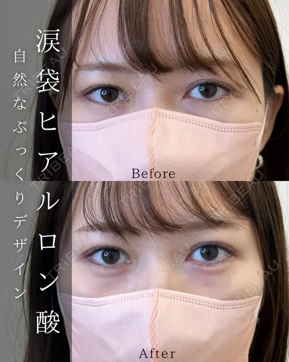 涙袋ヒアルロン酸 before画像 メイン用