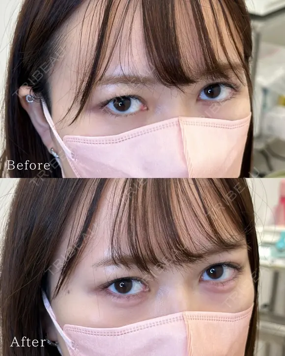 涙袋ヒアルロン酸 after画像 メイン用