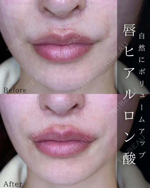 Cカールリップ before画像 メイン用