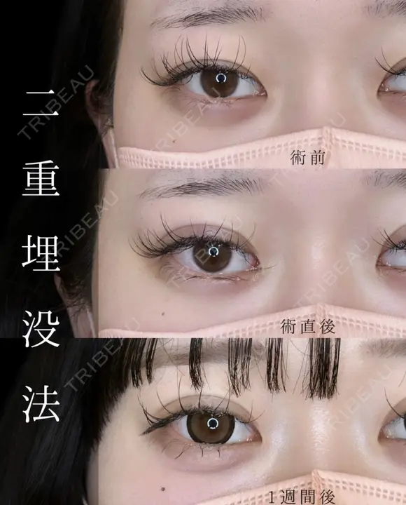 二重埋没法 before画像 メイン用