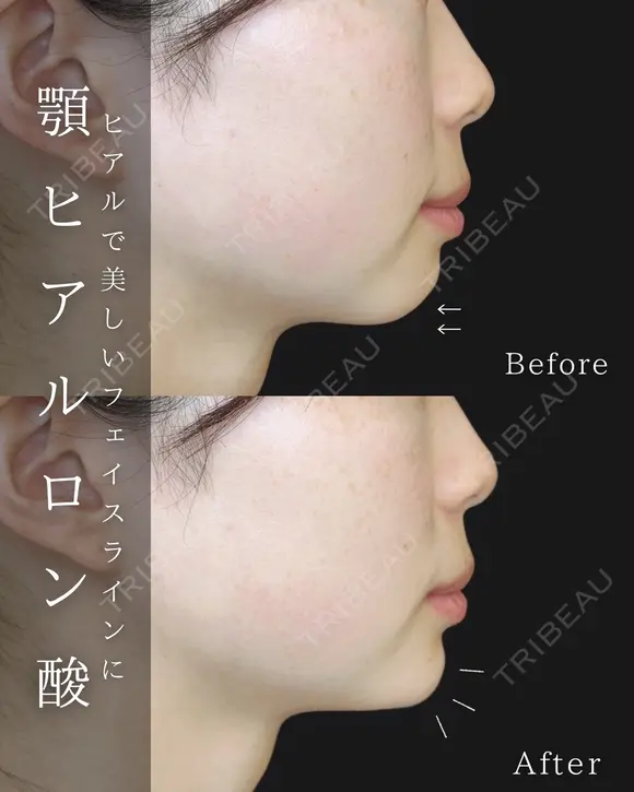 顎ヒアルロン酸 after画像 メイン用