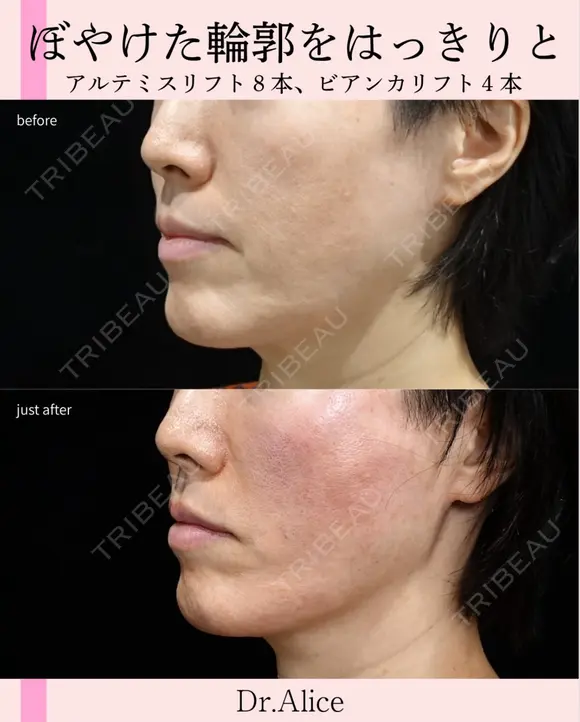 糸リフト after画像 メイン用